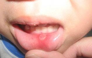 oorzaken van stomatitis bij kinderen